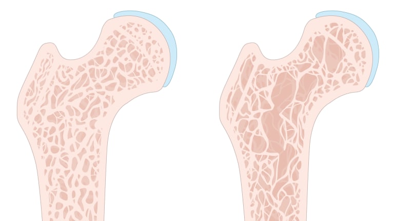 Osteoporosis, Rheumatoid Arthritis, and Women: Knowledge Is Power