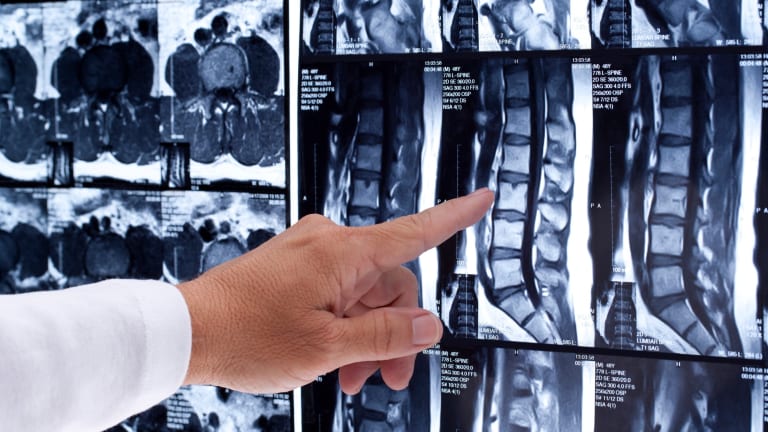 Non-radiographic Ankylosing Spondylitis Symptoms Improved with Biologic Therapy