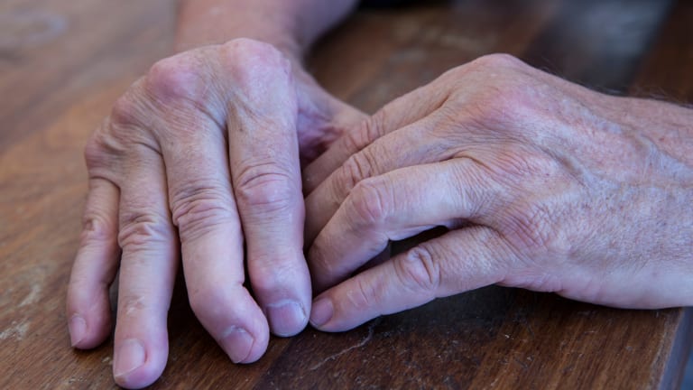 Management & Treatment of Psoriatic Arthritis