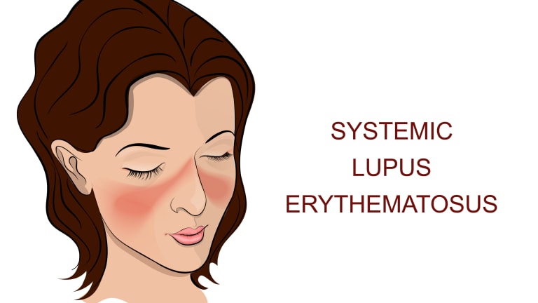 Could Stelara be the Next Treatment for Systemic Lupus Erythematosus?