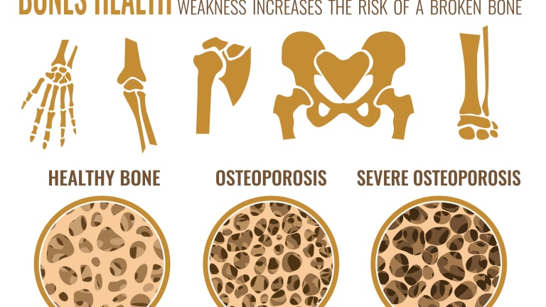 Short-Term Evenity Effective in RA & Osteoporosis