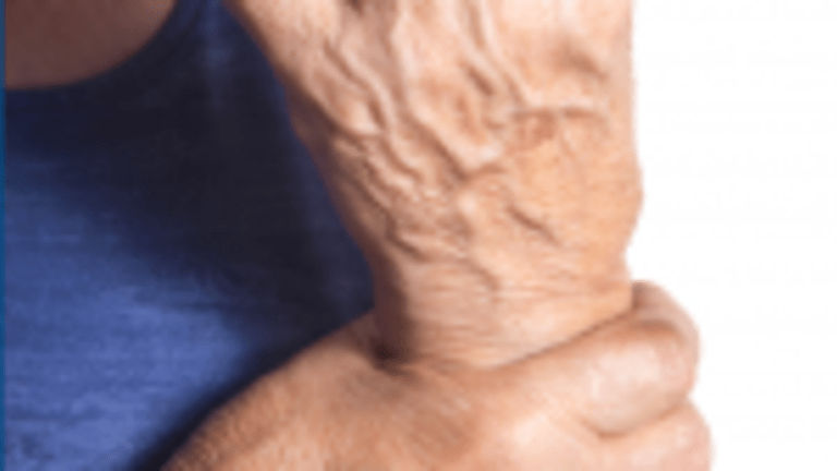 Hand Exercises Prove Beneficial and Cost Effective in Rheumatoid Arthritis