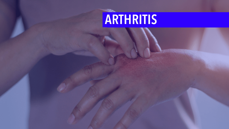 Managing Inflammatory Arthritis From Checkpoint Inhibitors