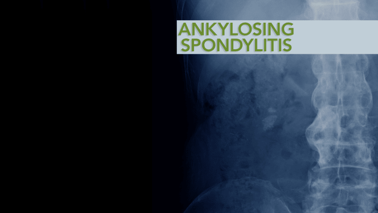 Treatment & Management of Ankylosing Spondylitis
