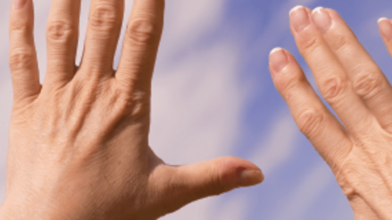 Insights into Rheumatoid Arthritis