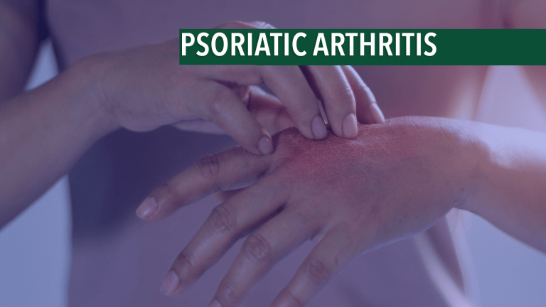 Updated Guidelines for Treating Psoriatic Arthritis Released
