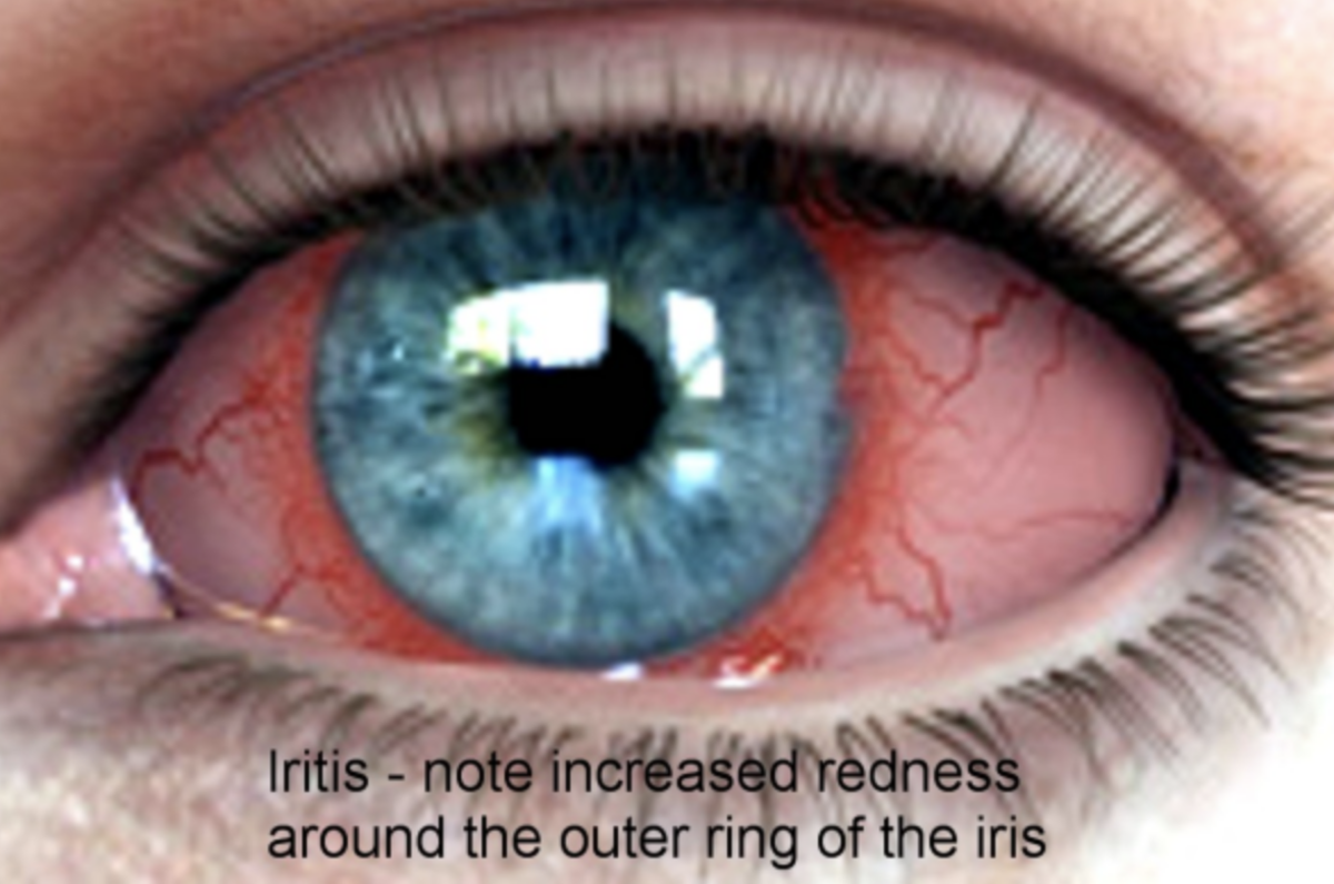 Why do Eyes Change Colour? - Dr. Jiwani & Associates