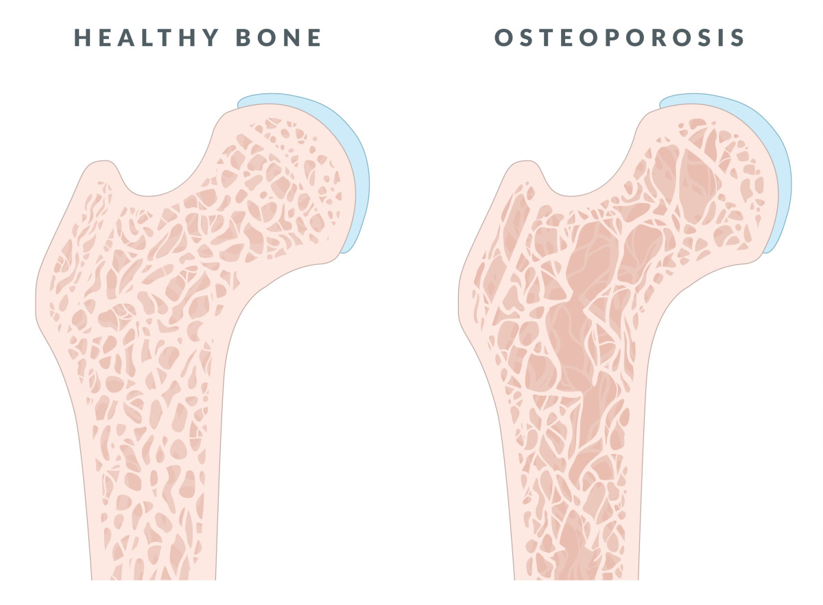 Osteoporosis, Rheumatoid Arthritis, and Women Knowledge Is Power The