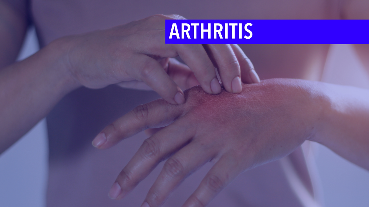 Managing Inflammatory Arthritis From Checkpoint Inhibitors The