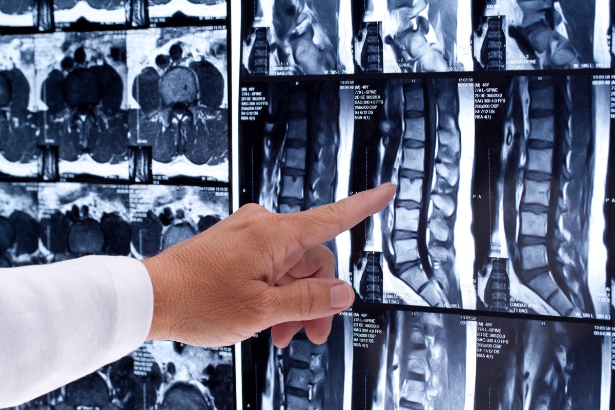 Nonradiographic Ankylosing Spondylitis Symptoms Improved with Biologic